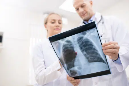 An X-ray showing lung cancer