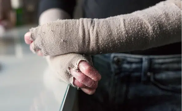 Close-up of a person with bandaged hands and partial finger amputation