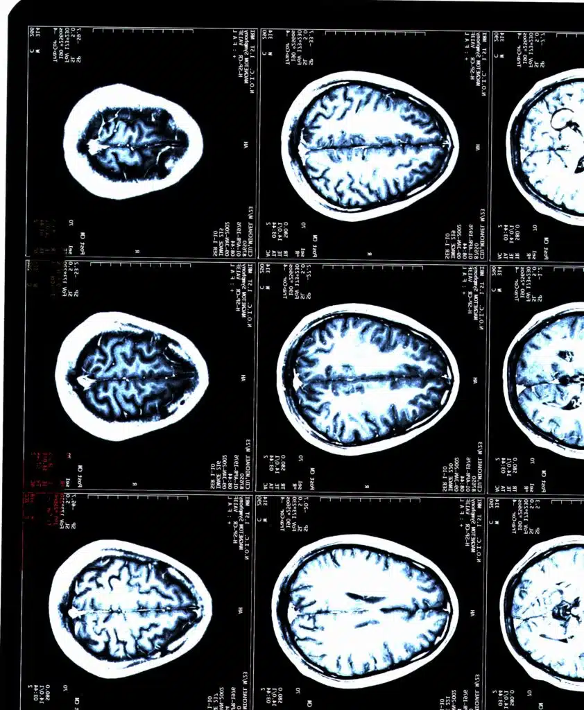 MRI brain scans of a patient with TBI
