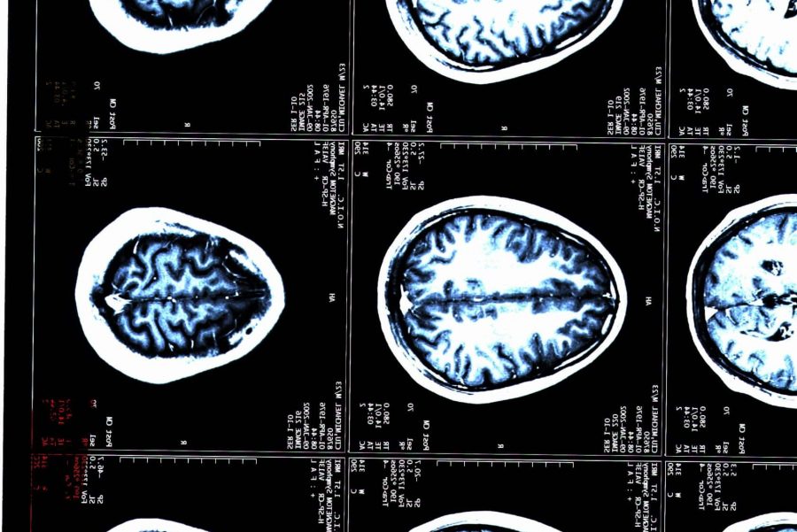 MRI brain scans of a patient with TBI